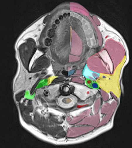 頸部MRIの正常解剖、間隙は積極的に取り扱わない方向に！